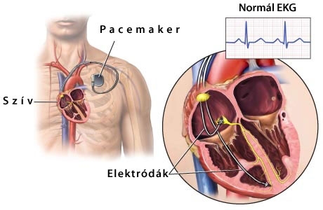 A szívritmus-szabályozó (pacemaker) A szívritmus-szabályozó (pacemaker)